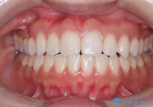 「歯を抜かずに、たった10ヵ月。」目立ちにくい大人の矯正の治療後