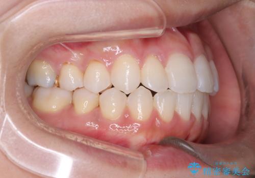 「歯を抜かずに、たった10ヵ月。」目立ちにくい大人の矯正の治療後