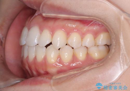 「歯を抜かずに、たった10ヵ月。」目立ちにくい大人の矯正の治療後