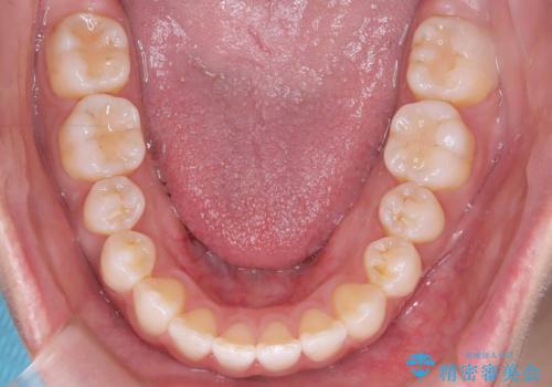 「歯を抜かずに、たった10ヵ月。」目立ちにくい大人の矯正の治療後