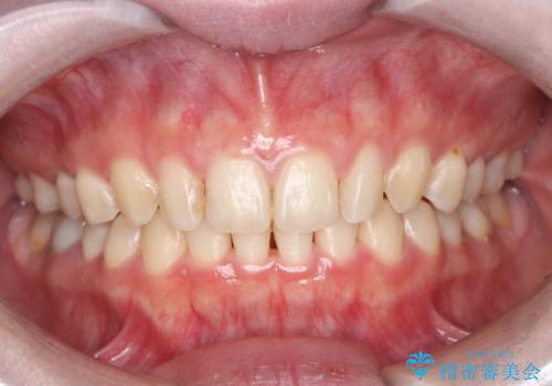 オフィスホワイトニングの治療前