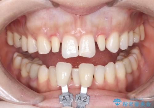 矯正後、矮小歯をオールセラミッククラウンで審美修復の治療中