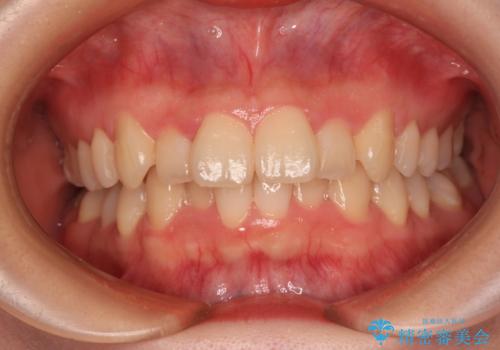 飛び出した前歯を引っ込める　ワイヤー装置の非抜歯矯正