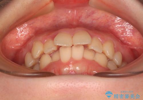 飛び出した前歯を引っ込める　ワイヤー装置の非抜歯矯正の治療前