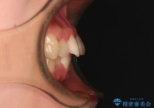 飛び出した前歯を引っ込める ワイヤー装置の非抜歯矯正の治療前