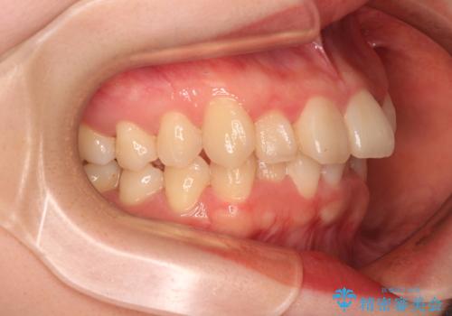 飛び出した前歯を引っ込める　ワイヤー装置の非抜歯矯正の治療前