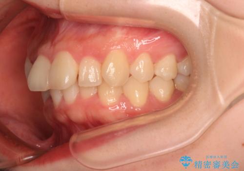 飛び出した前歯を引っ込める ワイヤー装置の非抜歯矯正の治療前
