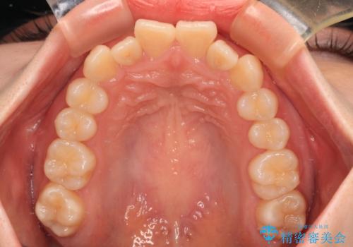 飛び出した前歯を引っ込める ワイヤー装置の非抜歯矯正の治療前