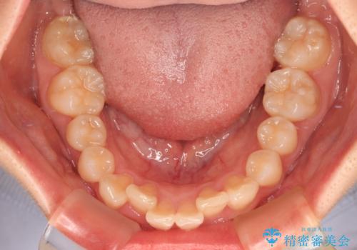飛び出した前歯を引っ込める ワイヤー装置の非抜歯矯正の治療前