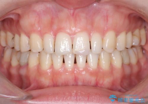 矯正後、矮小歯をオールセラミッククラウンで審美修復の治療前