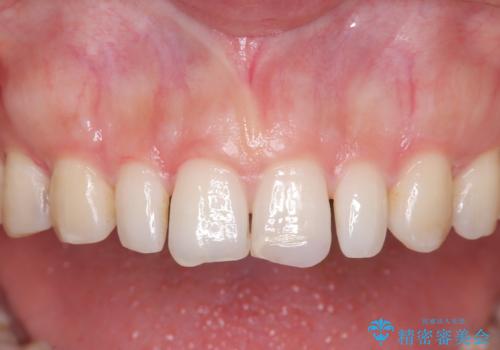 矯正後、矮小歯をオールセラミッククラウンで審美修復の治療前