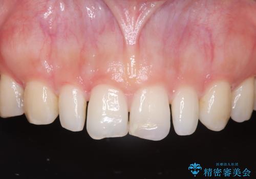 矯正後、矮小歯をオールセラミッククラウンで審美修復の治療前