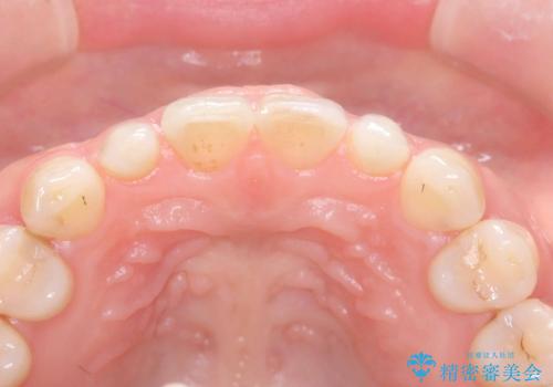矯正後、矮小歯をオールセラミッククラウンで審美修復の治療前