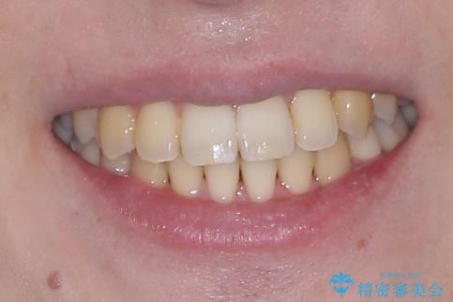 下顎の叢生を抜歯矯正で改善|費用を抑えたメタルブラケット矯正の治療後(顔貌)