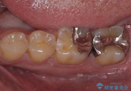 銀歯を白くしたい　セラミックインレー修復の症例 治療前