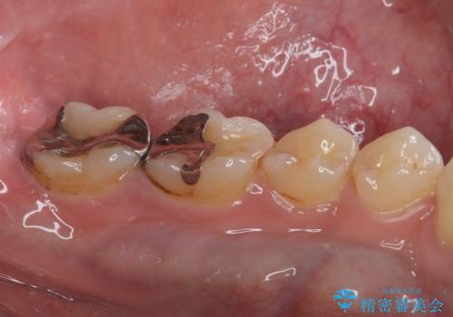 銀歯を白くしたい　セラミックインレー修復の治療前