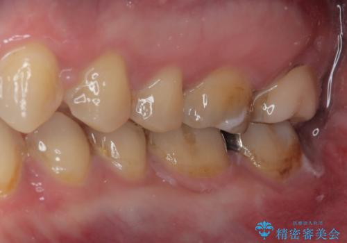銀歯を白くしたい　セラミックインレー修復の治療前