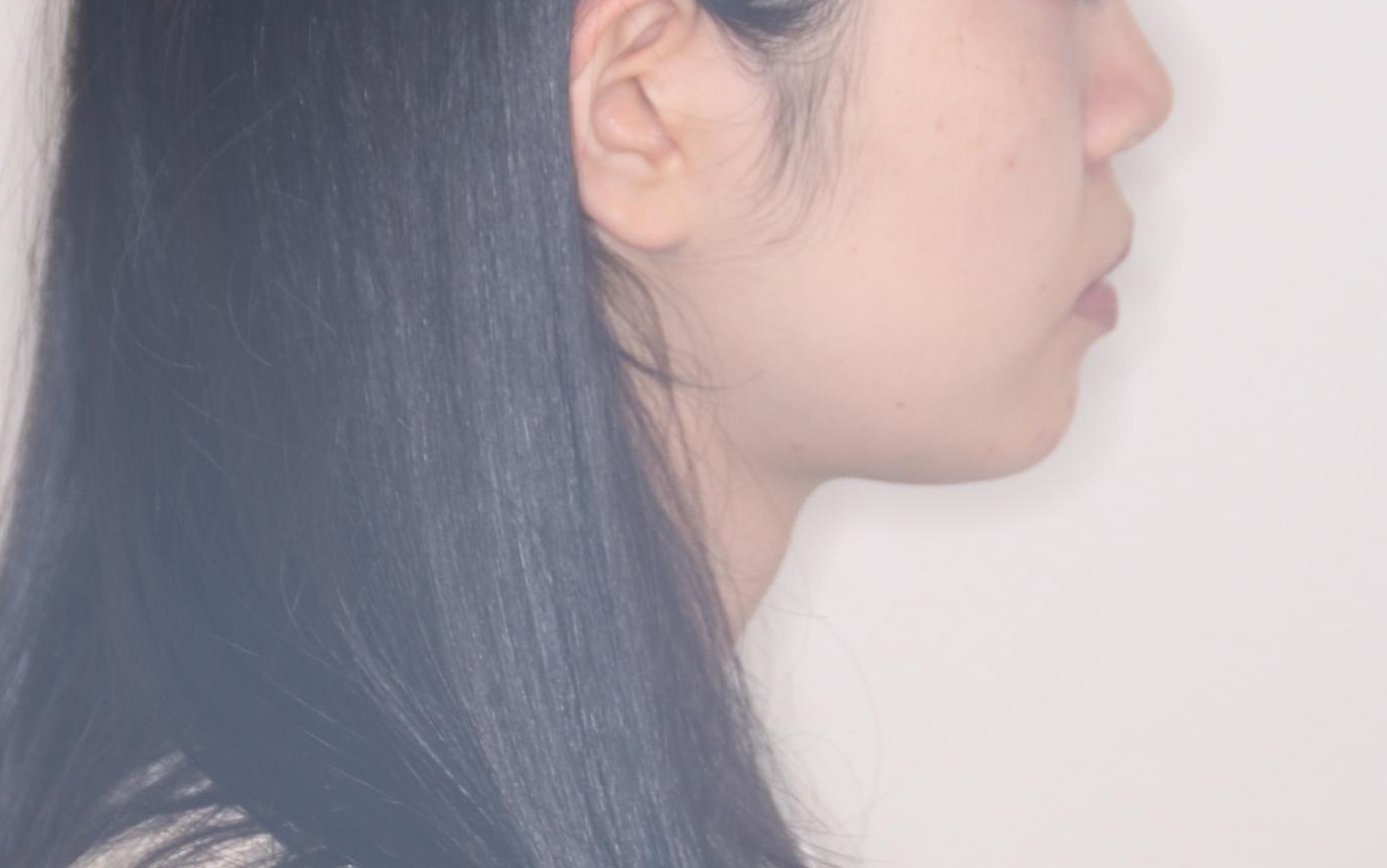 【ワイヤー矯正】前歯の突出感、下の歯の並びを良くしたいの治療後(顔貌)