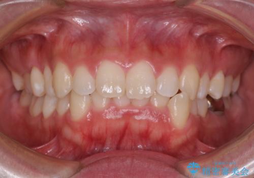 口ゴボが気になる 上下4本の抜歯矯正の治療前