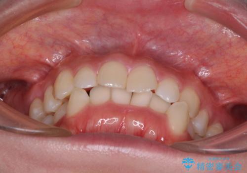 口ゴボが気になる 上下4本の抜歯矯正の治療前