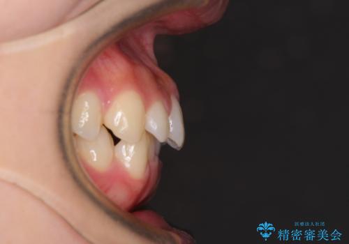 口ゴボが気になる　上下4本の抜歯矯正