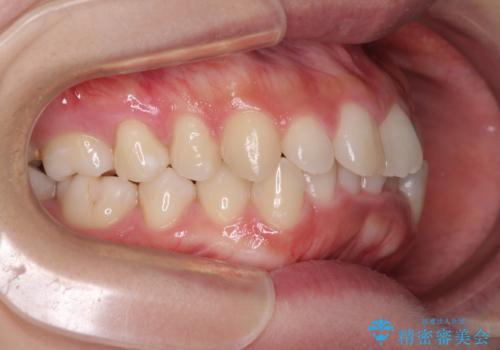 口ゴボが気になる 上下4本の抜歯矯正の治療前