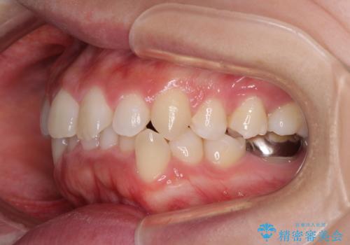 口ゴボが気になる　上下4本の抜歯矯正の治療前