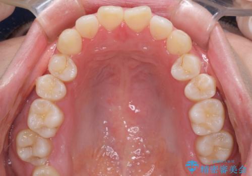 口ゴボが気になる 上下4本の抜歯矯正の治療前