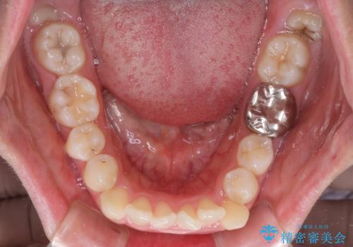 口ゴボが気になる　上下4本の抜歯矯正の治療前