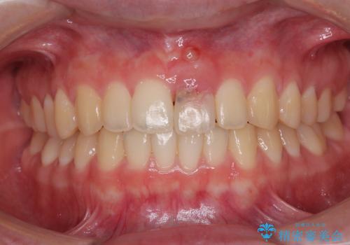 歯根吸収した前歯　短期間でのインプラント治療の治療前