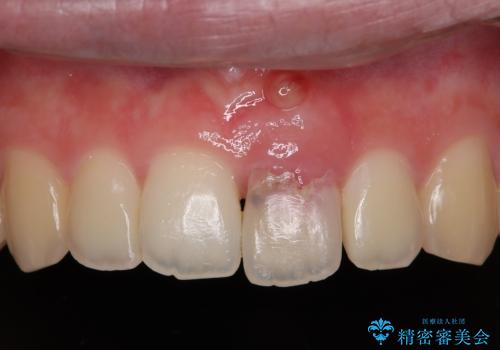 歯根吸収した前歯　短期間でのインプラント治療