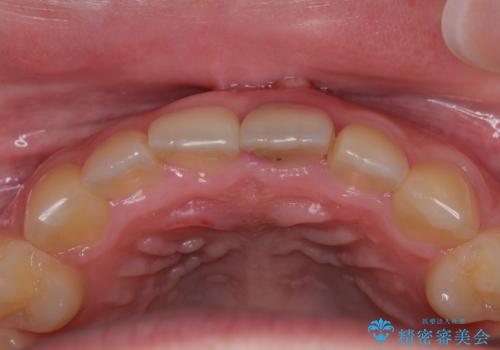 歯根吸収した前歯 短期間でのインプラント治療の治療前
