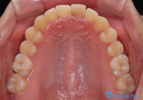 歯根吸収した前歯　短期間でのインプラント治療の治療前