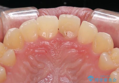 歯根吸収した前歯　短期間でのインプラント治療の治療前