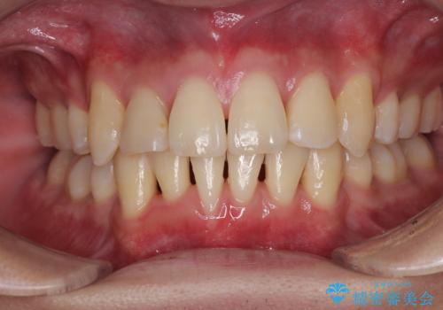 八重歯と重なった前歯 目立たない装置での抜歯矯正の症例 治療後