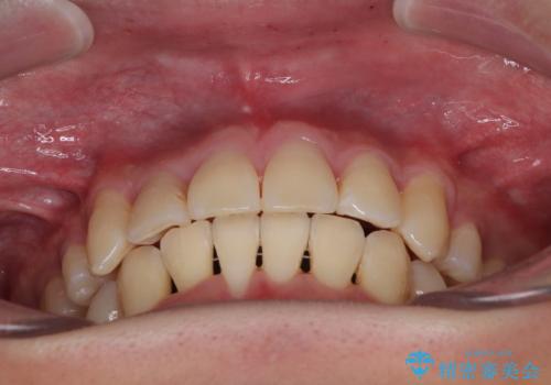 八重歯と重なった前歯　目立たない装置での抜歯矯正の治療後