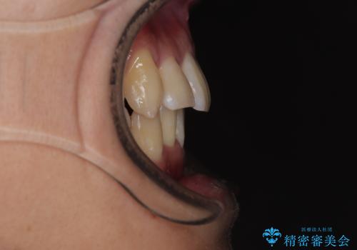 八重歯と重なった前歯　目立たない装置での抜歯矯正の治療後