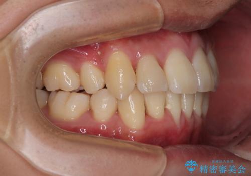 八重歯と重なった前歯　目立たない装置での抜歯矯正の治療後