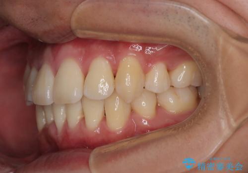 八重歯と重なった前歯　目立たない装置での抜歯矯正の治療後