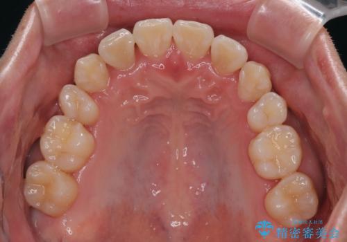 八重歯と重なった前歯　目立たない装置での抜歯矯正の治療後