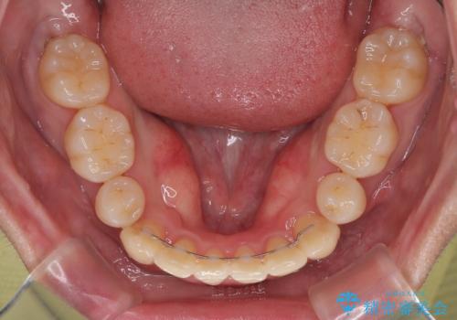 八重歯と重なった前歯　目立たない装置での抜歯矯正の治療後