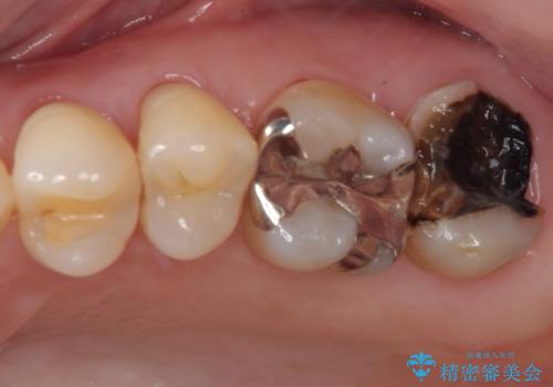 放置した奥歯のむし歯 ゴールドクラウン補綴治療の症例 治療前