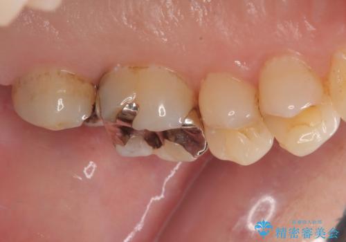 放置した奥歯のむし歯　ゴールドクラウン補綴治療の治療前