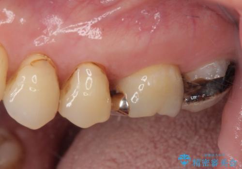 放置した奥歯のむし歯　ゴールドクラウン補綴治療の治療前