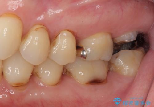 放置した奥歯のむし歯 ゴールドクラウン補綴治療の治療前