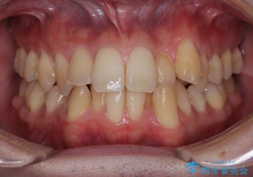 下顎の叢生を抜歯矯正で改善|費用を抑えたメタルブラケット矯正の治療前