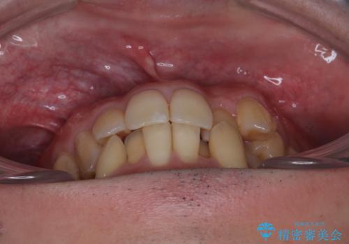 下顎の叢生を抜歯矯正で改善|費用を抑えたメタルブラケット矯正の治療前