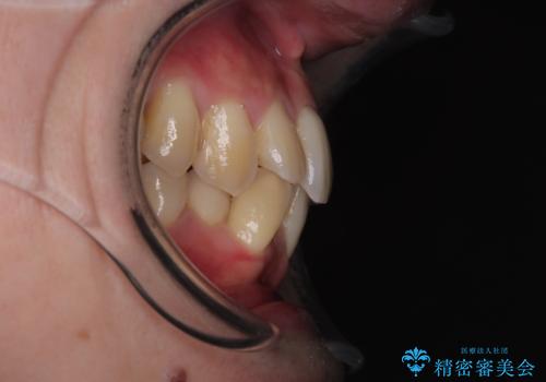 下顎の叢生を抜歯矯正で改善|費用を抑えたメタルブラケット矯正の治療前