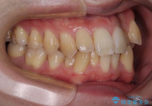 下顎の叢生を抜歯矯正で改善|費用を抑えたメタルブラケット矯正の治療前