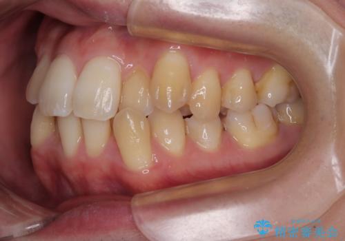 下顎の叢生を抜歯矯正で改善|費用を抑えたメタルブラケット矯正の治療前